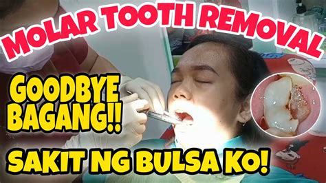 Tooth extraction(bunot sa bagang) .
